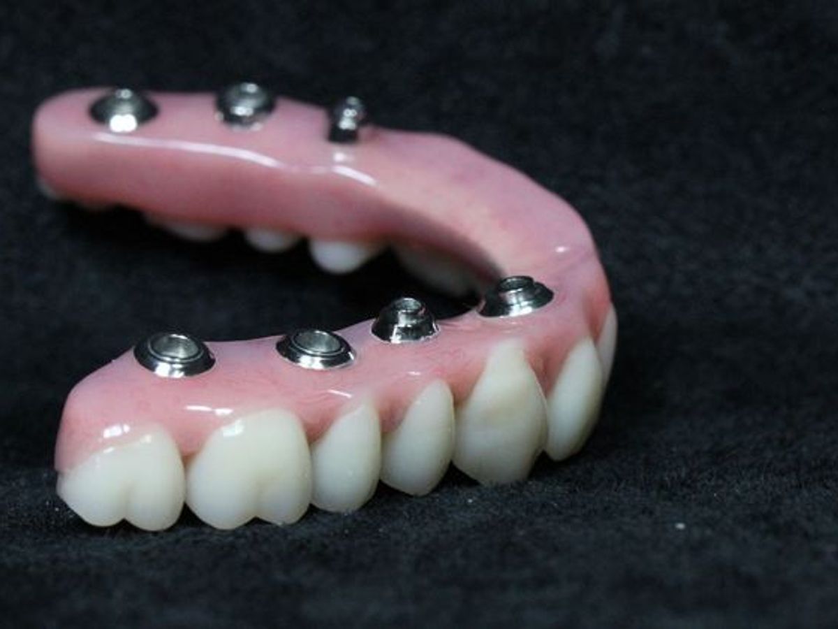 Teeth in a Day: Case 20 — Final Upper Restoration / Final Restoration before
