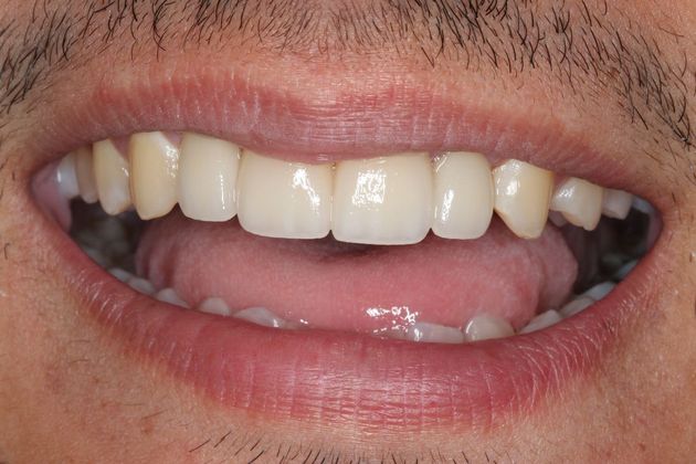 Dental Implants: Case 6 — after