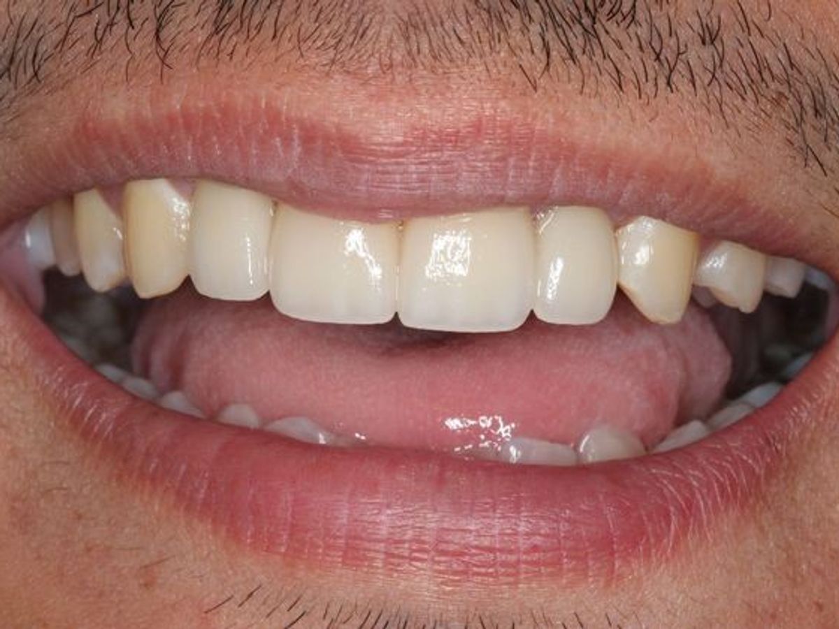Dental Implants: Case 6 — after