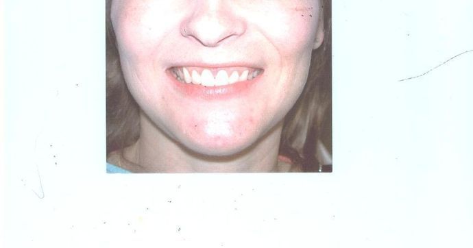 Gum Lift: Case 2 — after