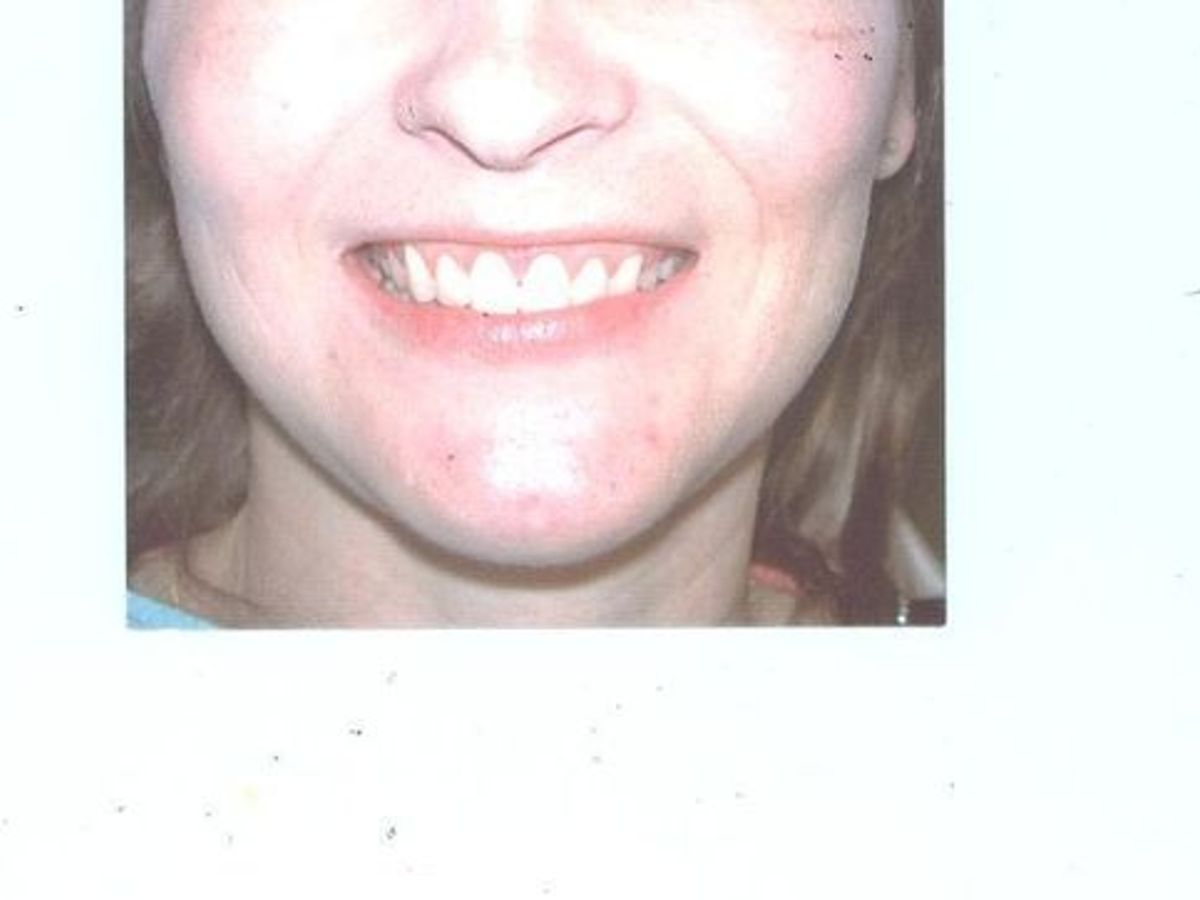 Gum Lift: Case 2 — after