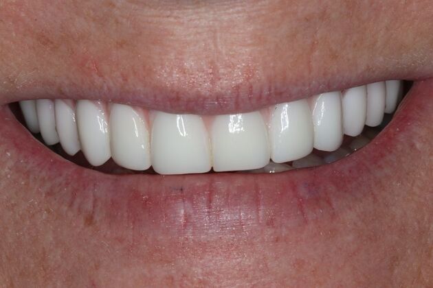 Teeth in a Day: Case 27 — after