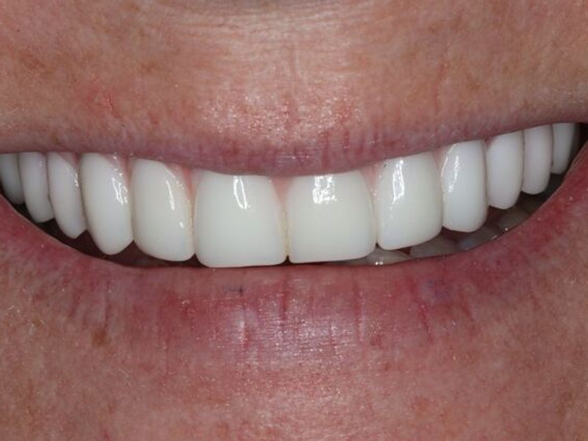 Teeth in a Day: Case 27 — after