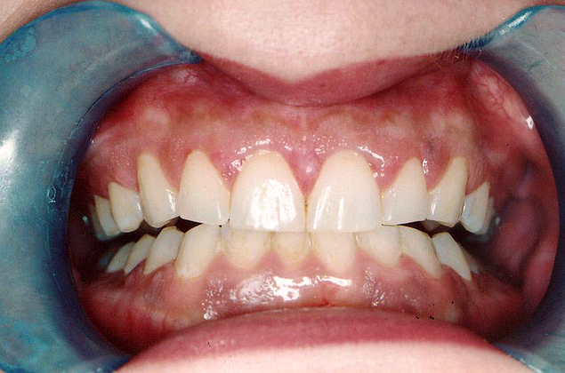 Gum Lift: Case 1 - After (Retract)