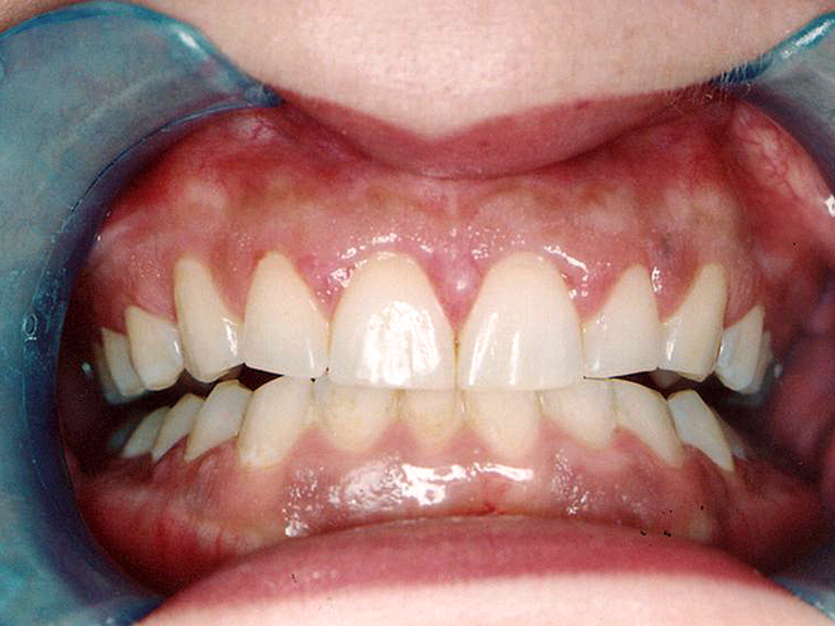 Gum Lift: Case 1 — Before (Retractors) / After (Retract) after