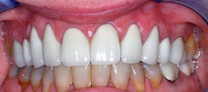 Veneers: Case 11 — after
