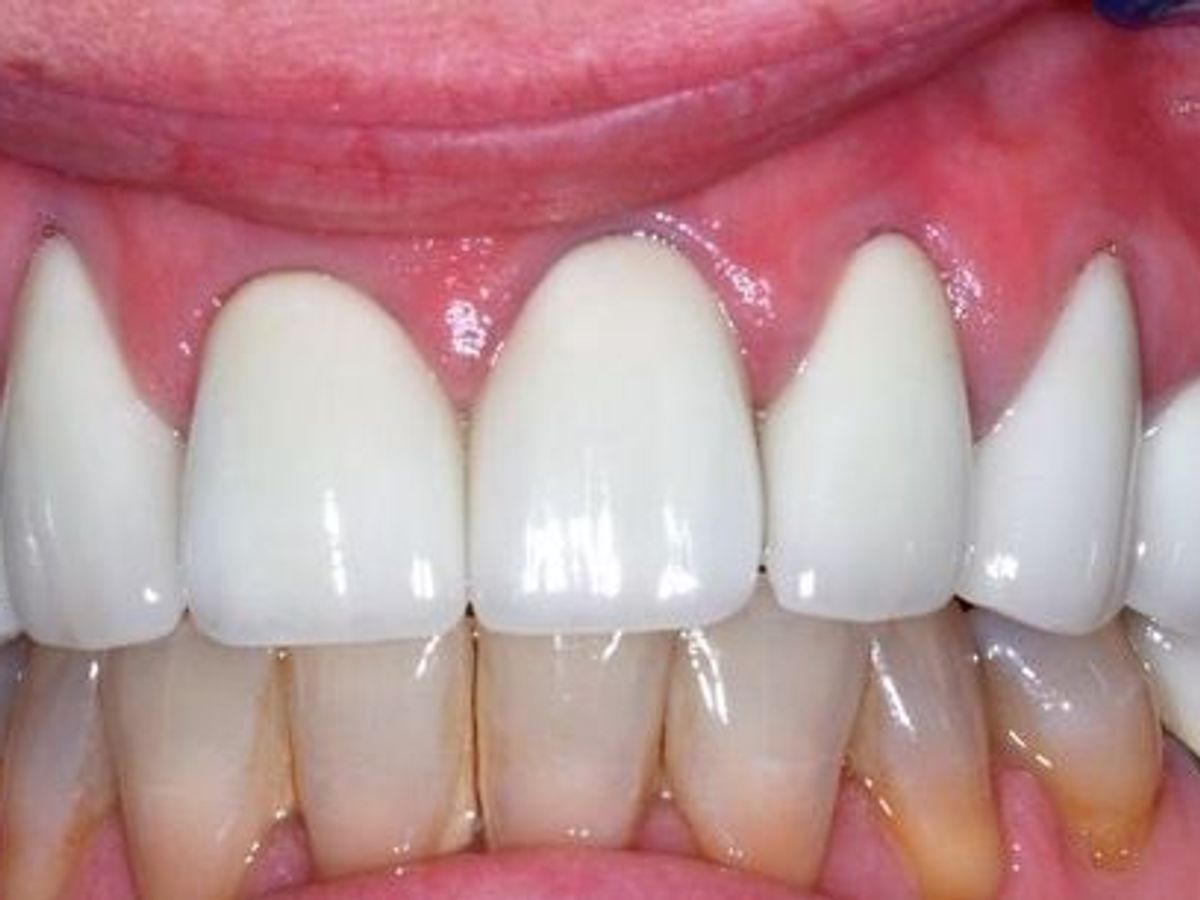 Veneers: Case 11 — after