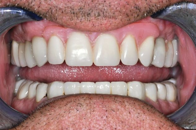 Dental Implants: Case 3 — after