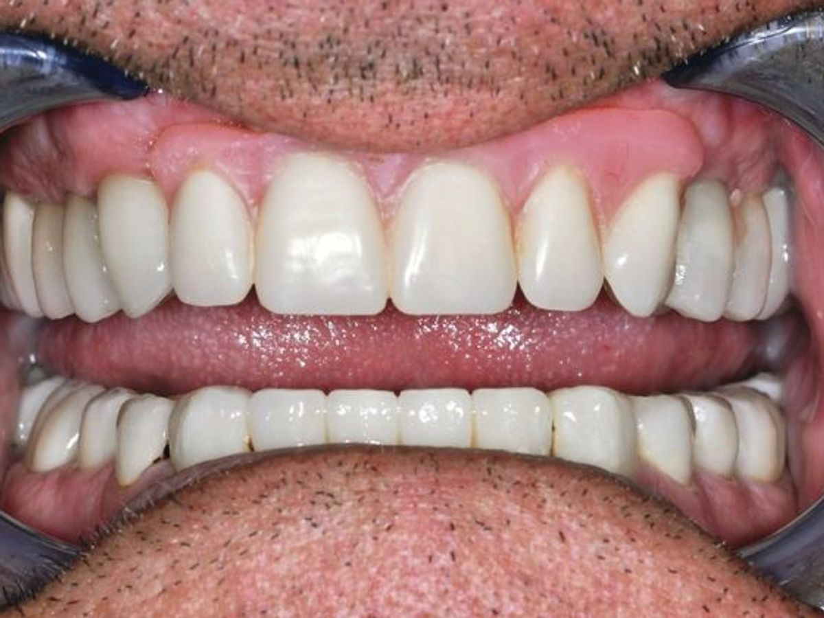 Dental Implants: Case 3 — after