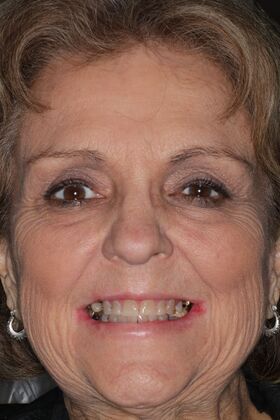 Full Mouth Reconstruction: Case 10 — before