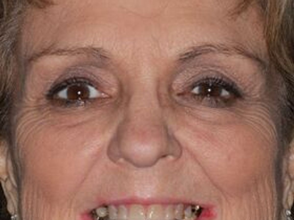 Full Mouth Reconstruction: Case 10 — before