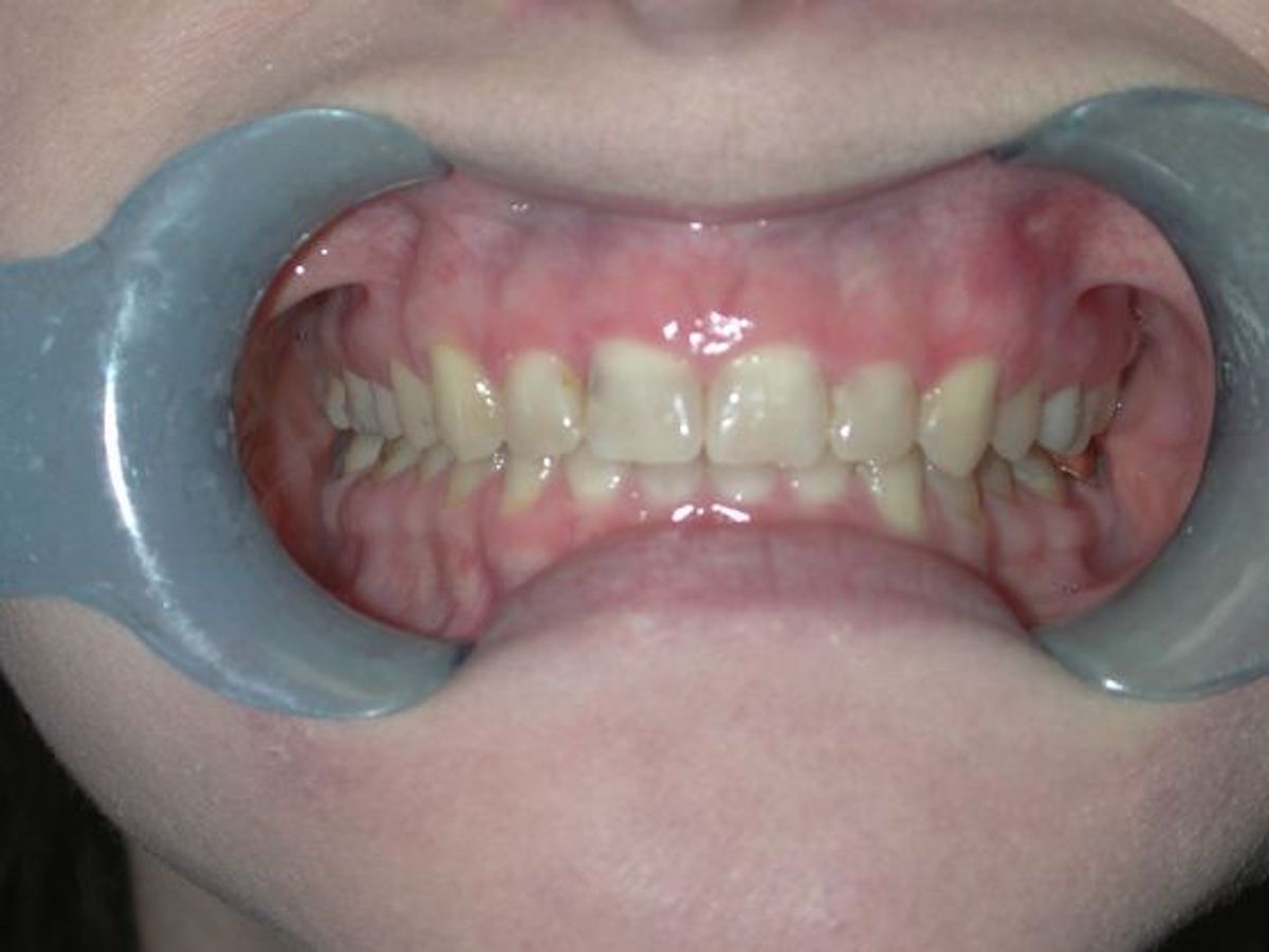 Gum Lift: Case 2 — before