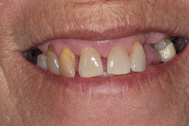 Teeth in a Day: Case 28 — before