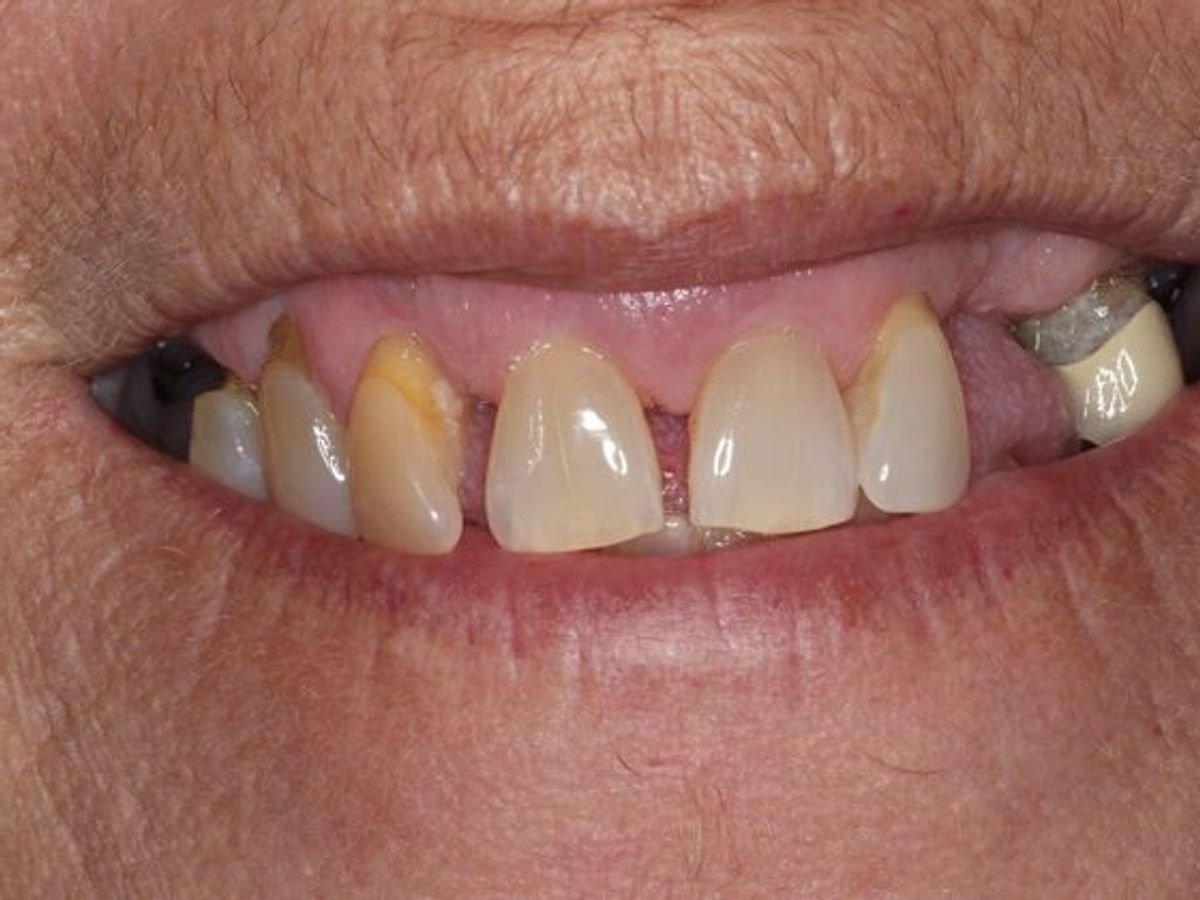 Teeth in a Day: Case 28 — before