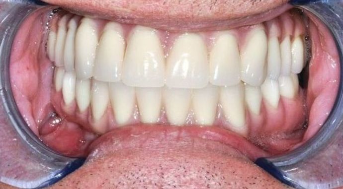 Teeth in a Day: Case 12 — Upper Arch after