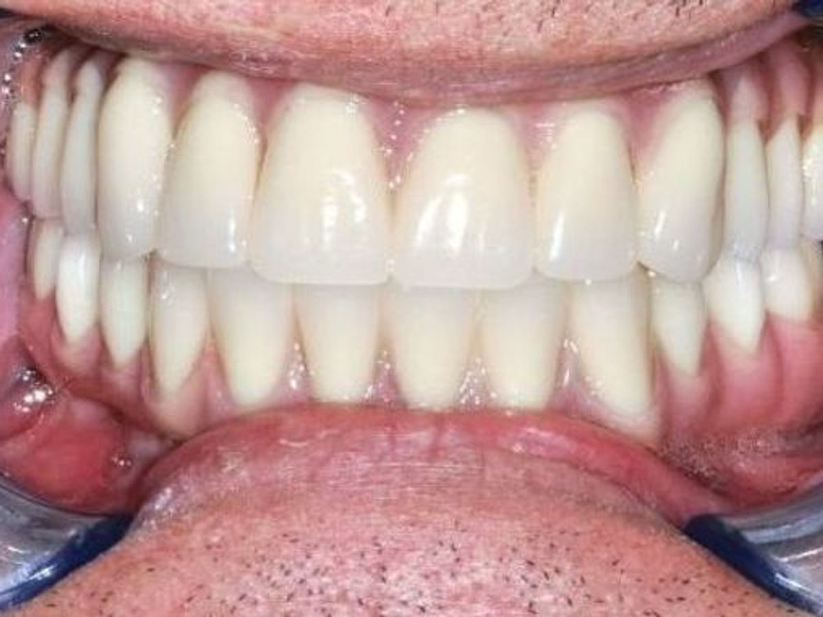 Teeth in a Day: Case 12 — Upper Arch after