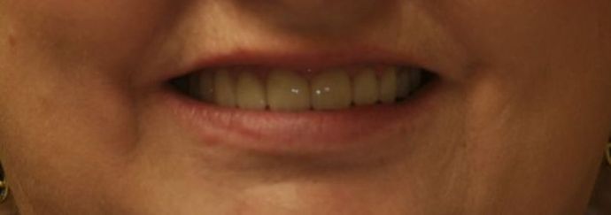 Dental Crowns: Case 14 — after