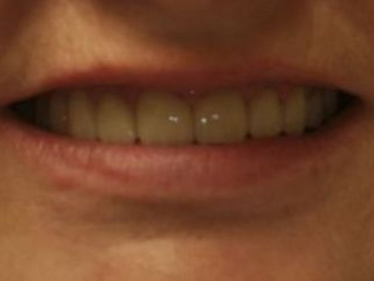 Dental Crowns: Case 14 — after