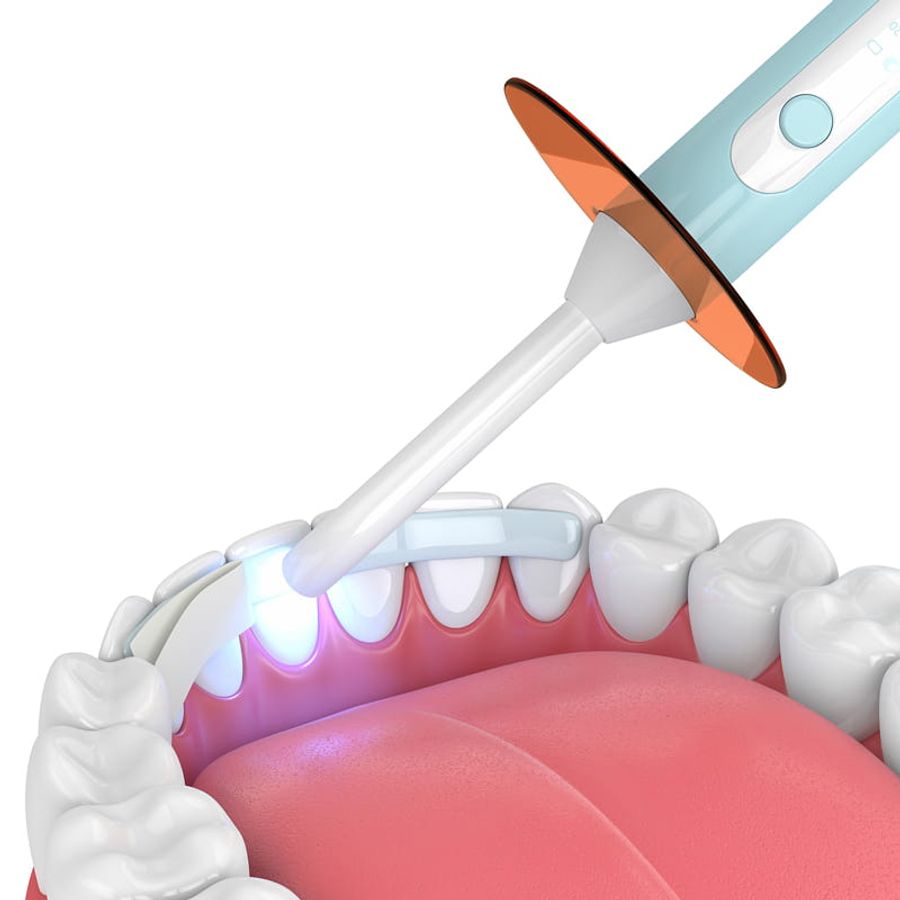 Teeth Whitening Treatments