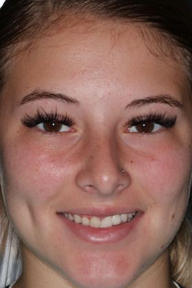 Veneers: Case 19 — before