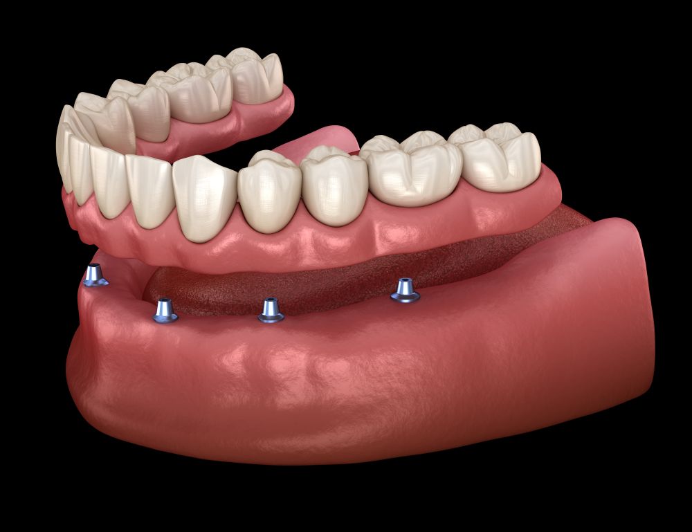 How to Clean and Maintain Your All-On-4 Dentures