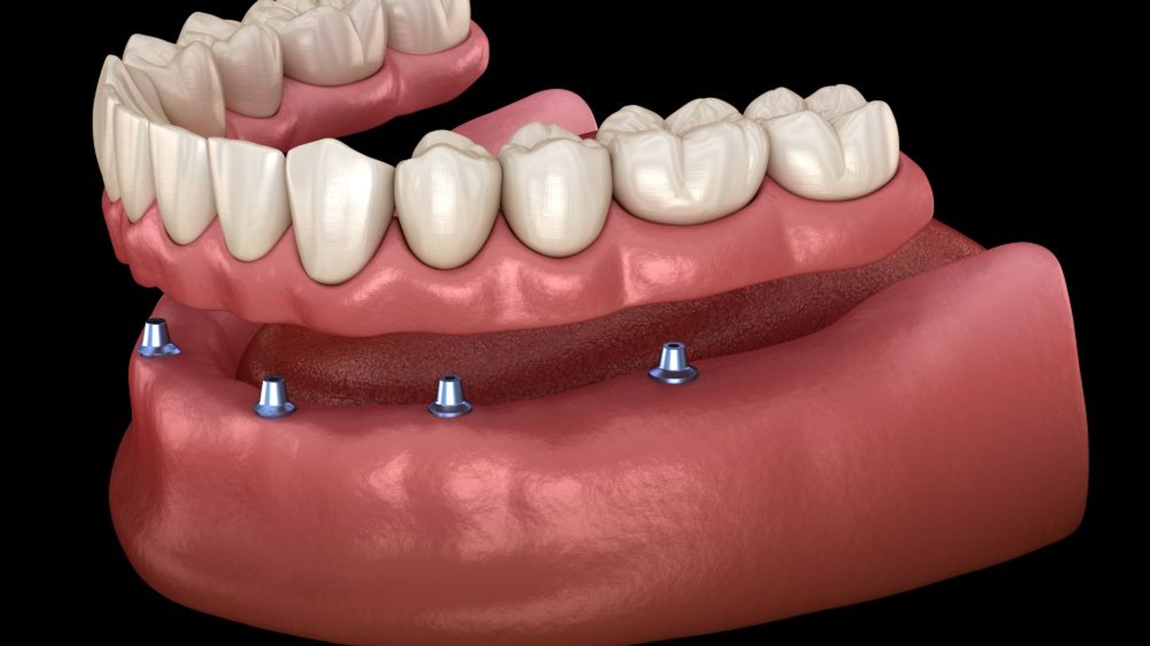 How to Clean and Maintain Your All-On-4 Dentures