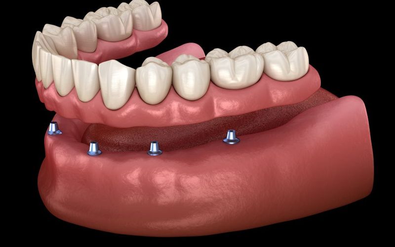 How to Clean and Maintain Your All-On-4 Dentures