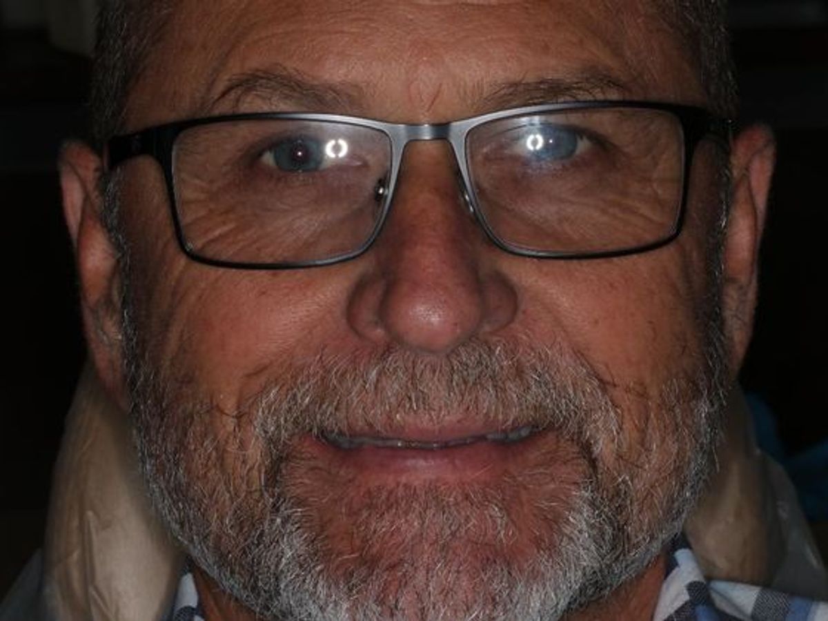 Full Mouth Reconstruction: Case 6 — before