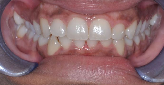 Gum Lift: Case 3 — 1 Month After Treatment before