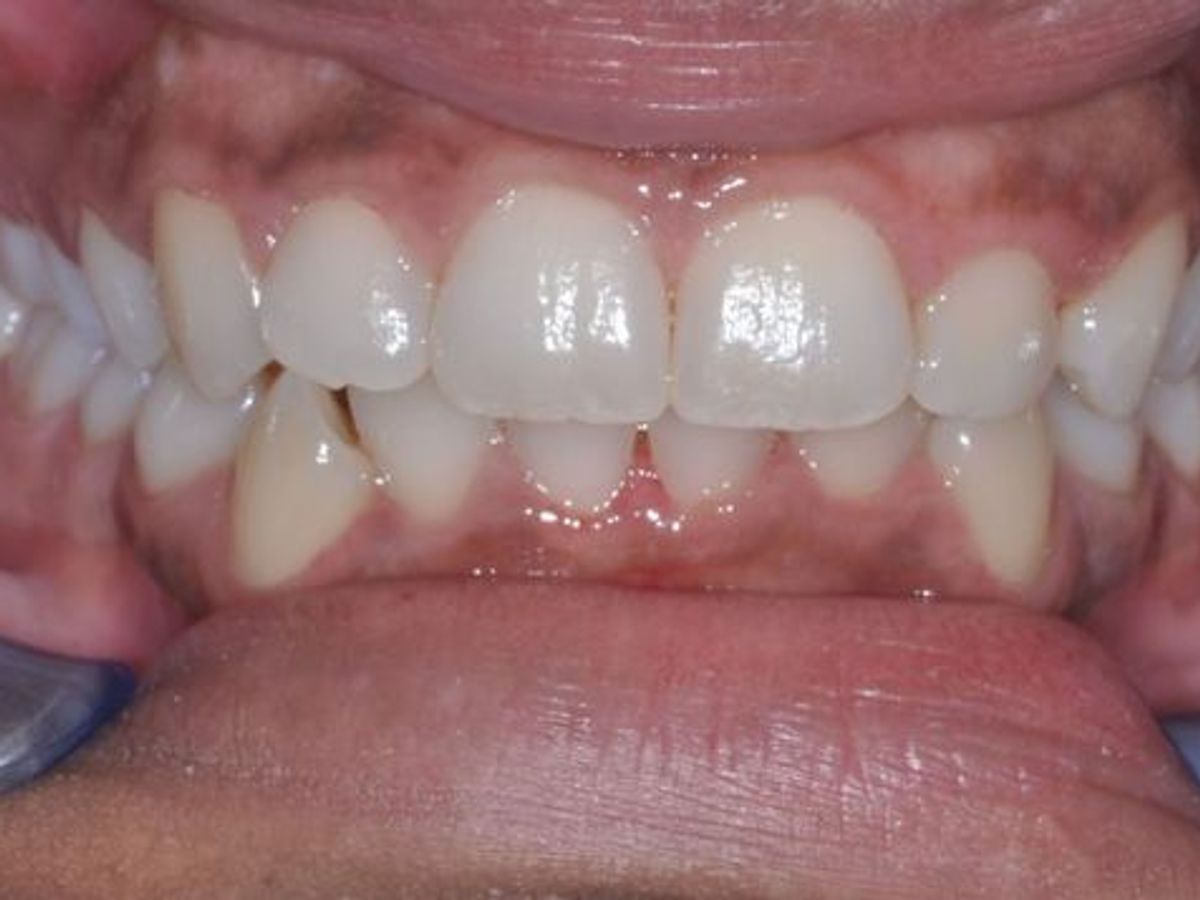 Gum Lift: Case 3 — 1 Month After Treatment before