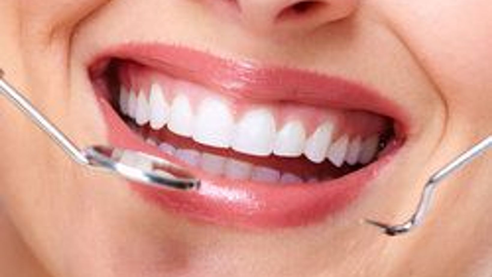 Benefits of Tooth-colored Fillings