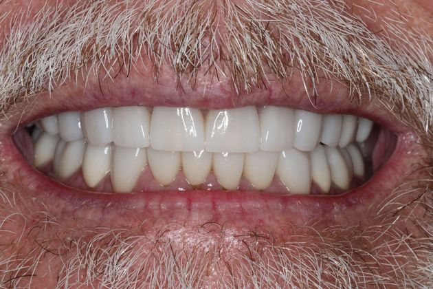 Full Mouth Reconstruction: Case 8 — after