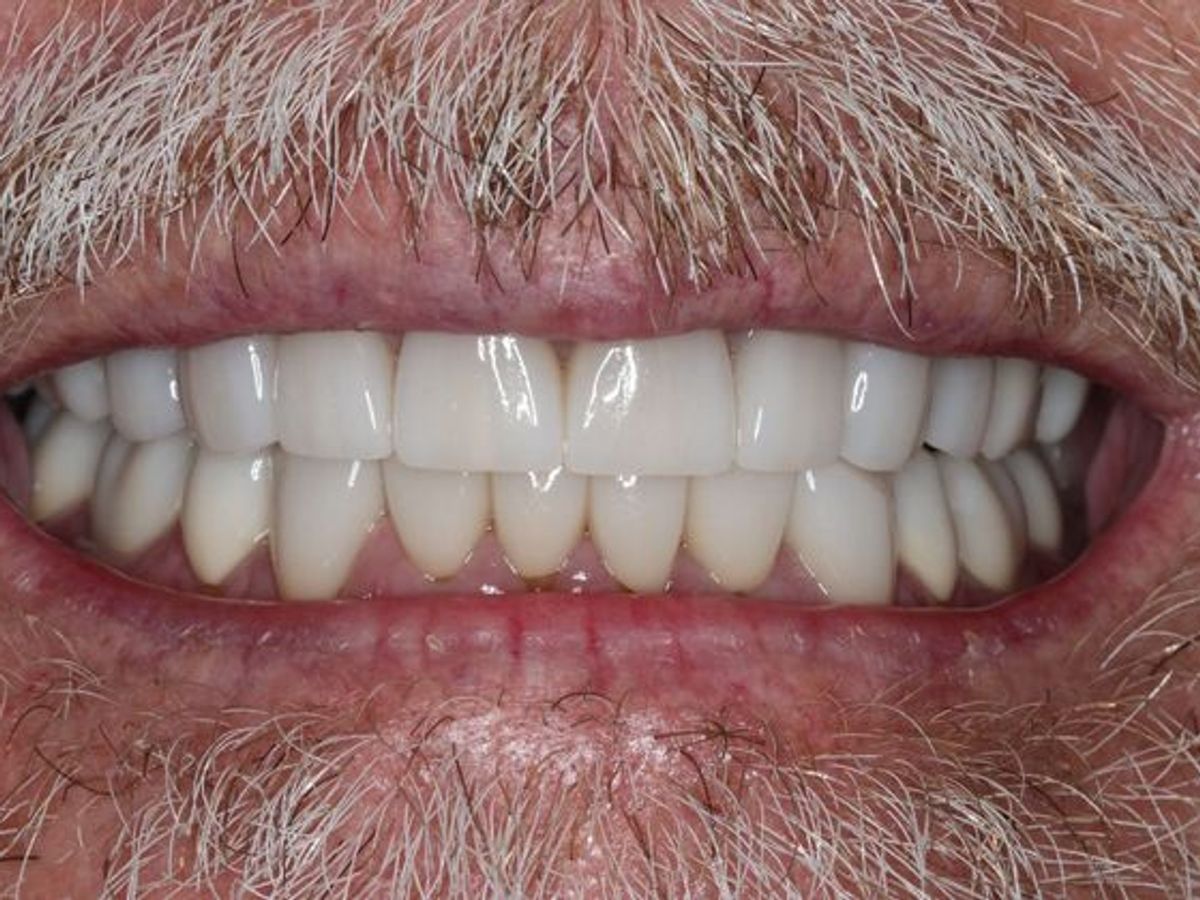 Full Mouth Reconstruction: Case 8 — after