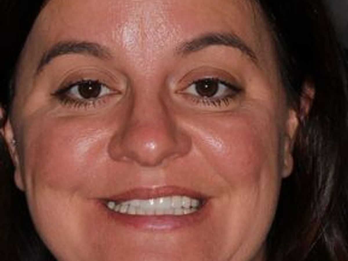 Veneers: Case 23 — after