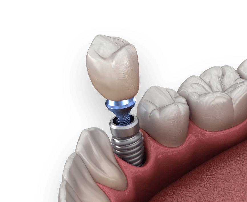 Understanding the Causes of Dental Implant Failure