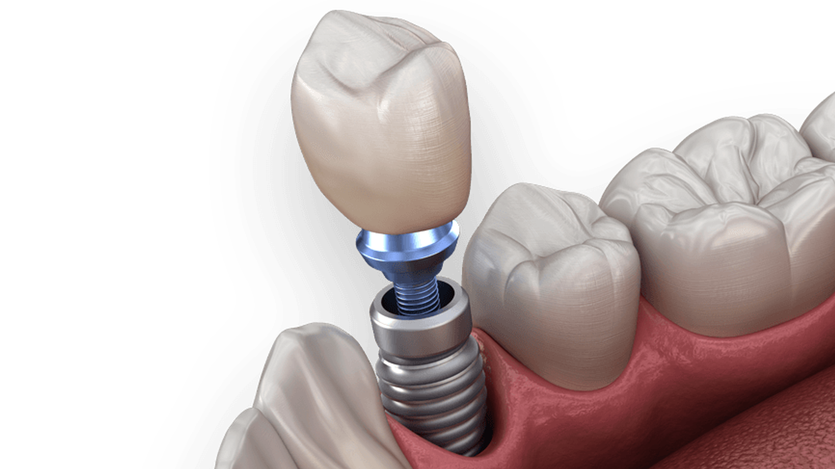 Understanding the Causes of Dental Implant Failure