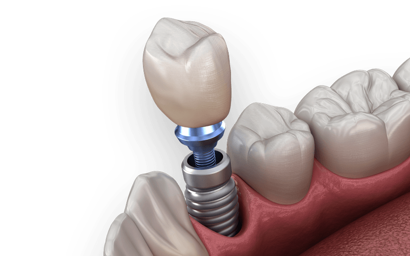Understanding the Causes of Dental Implant Failure