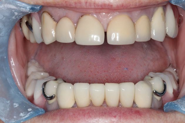 Dentures: Case 11 — after