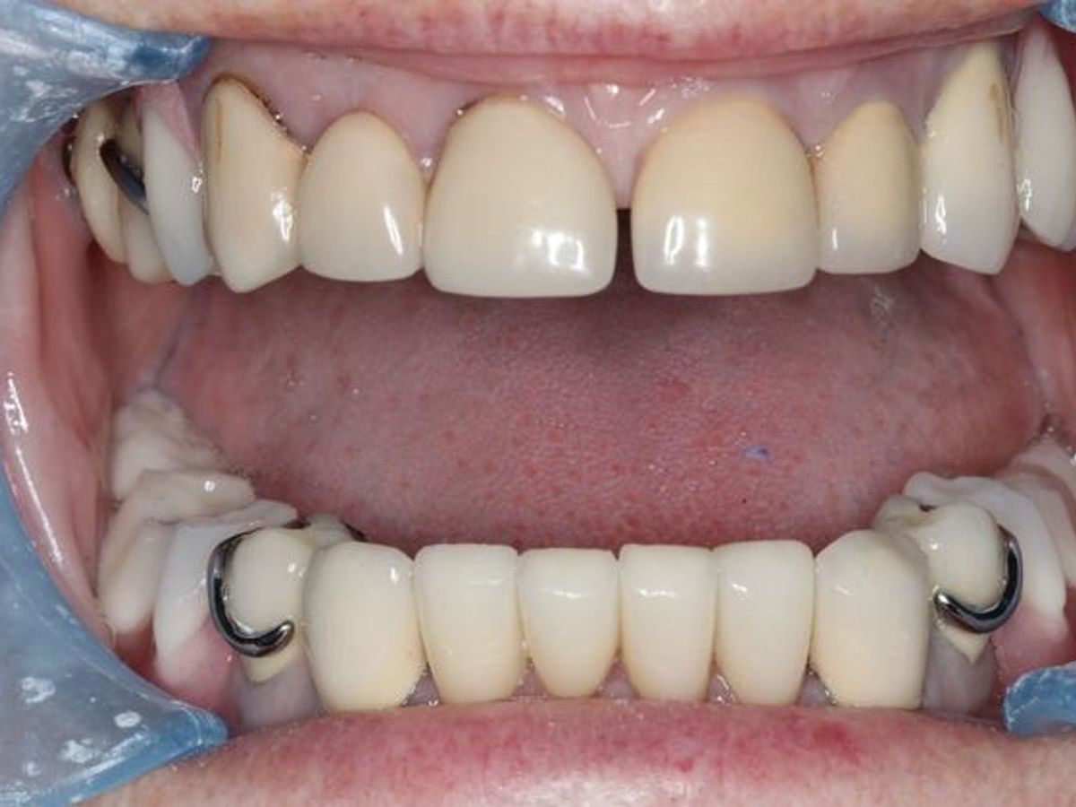 Dentures: Case 11 — after