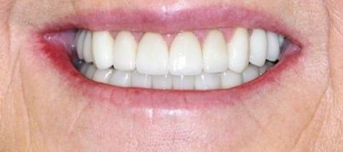 Dental Crowns: Case 9 — after