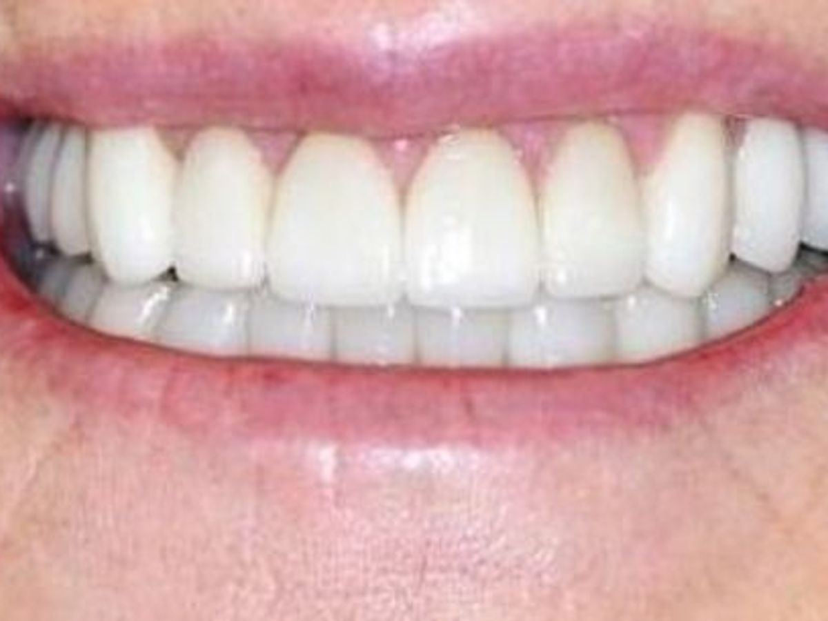 Dental Crowns: Case 9 — after