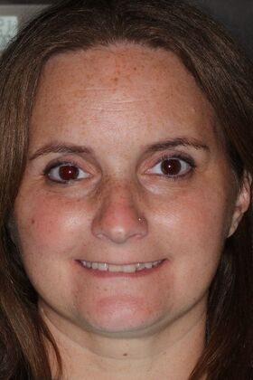 Veneers: Case 27 — before