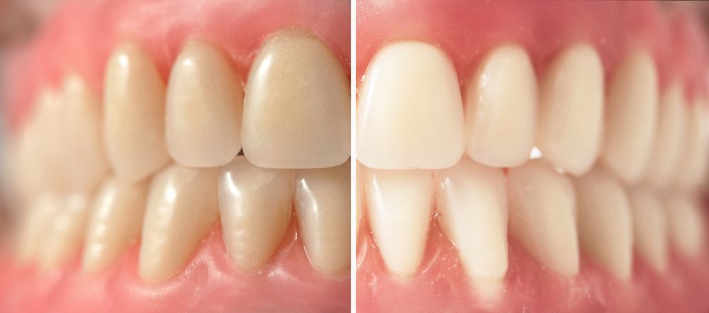 Intrinsic vs. Extrinsic Tooth Stains