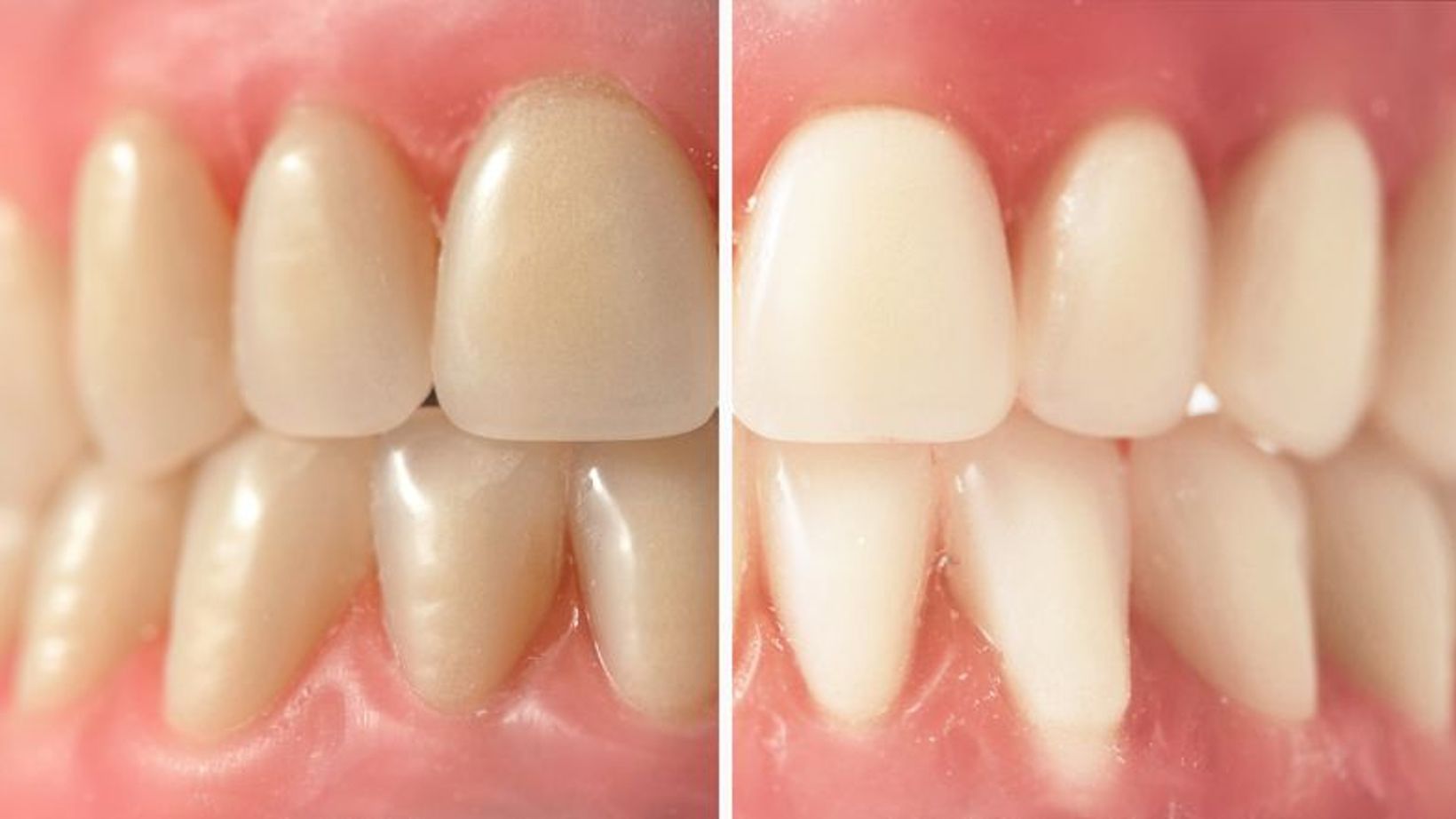 Intrinsic vs. Extrinsic Tooth Stains