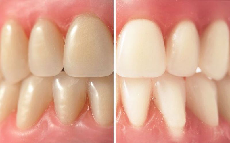 Intrinsic vs. Extrinsic Tooth Stains
