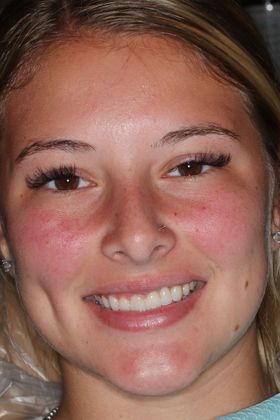 Veneers: Case 19 — after