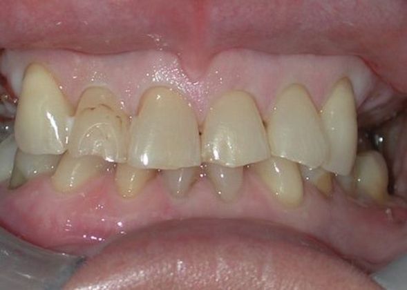 Full Mouth Reconstruction: Case 1 — before