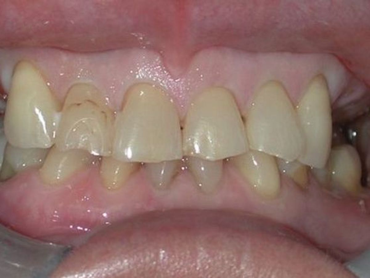 Full Mouth Reconstruction: Case 1 — before