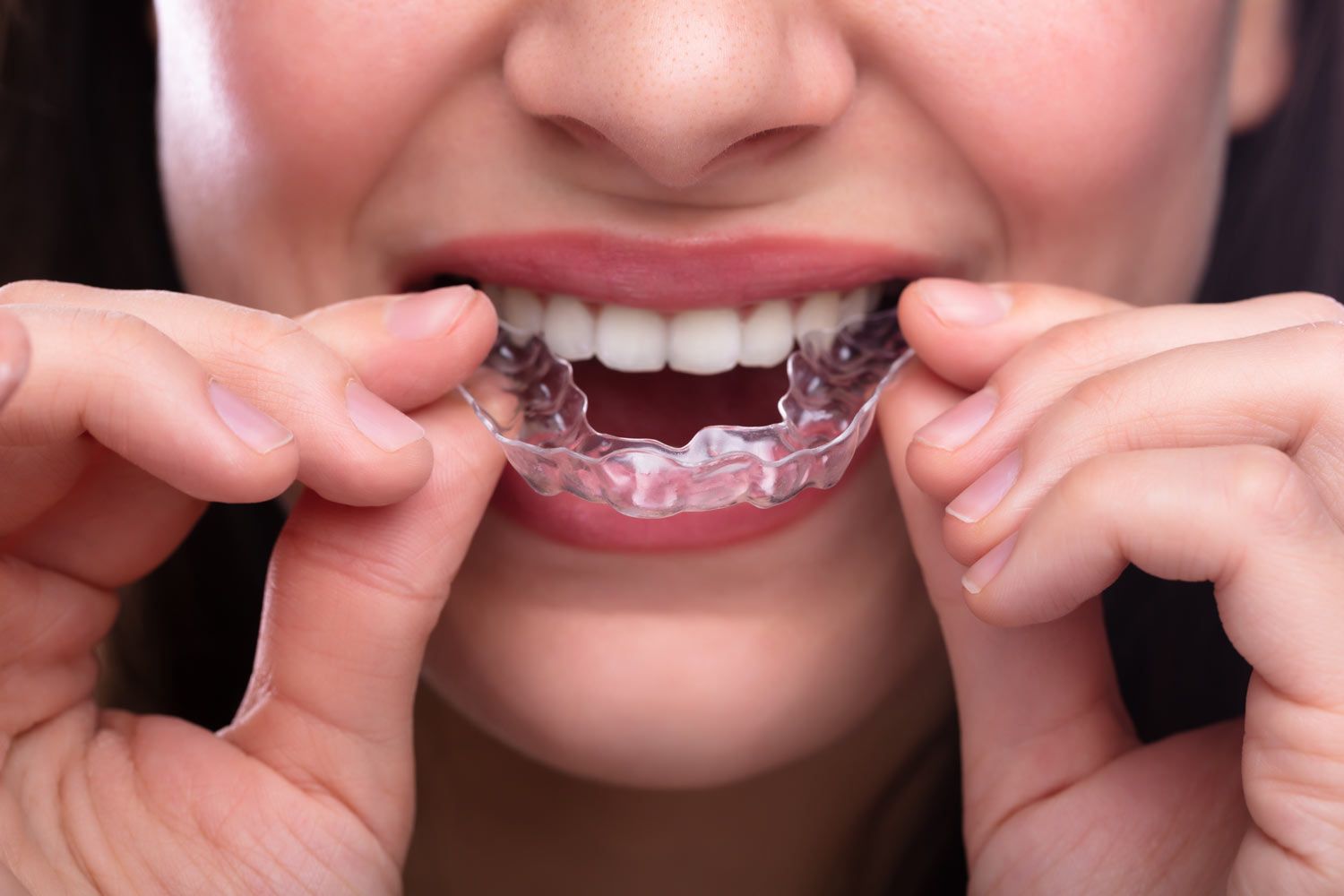 Is There an Ideal Age for Invisalign Treatment?