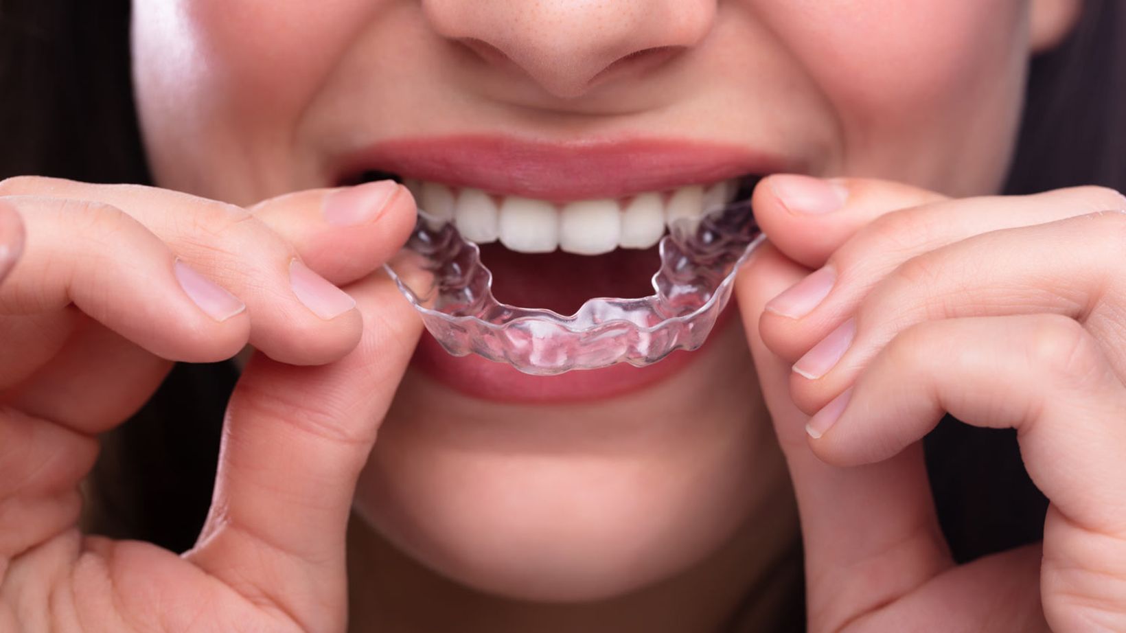 Is There an Ideal Age for Invisalign Treatment?